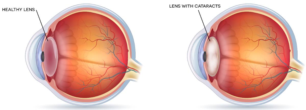 eye cataracts