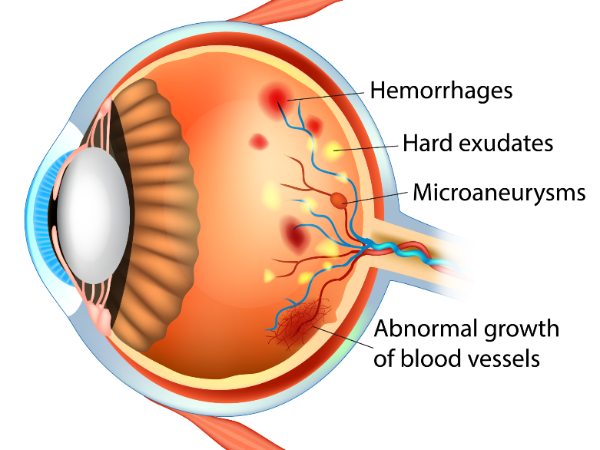 eye disease diabetics