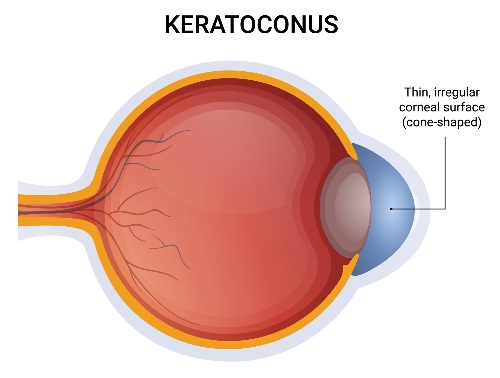 keratoconus-eye