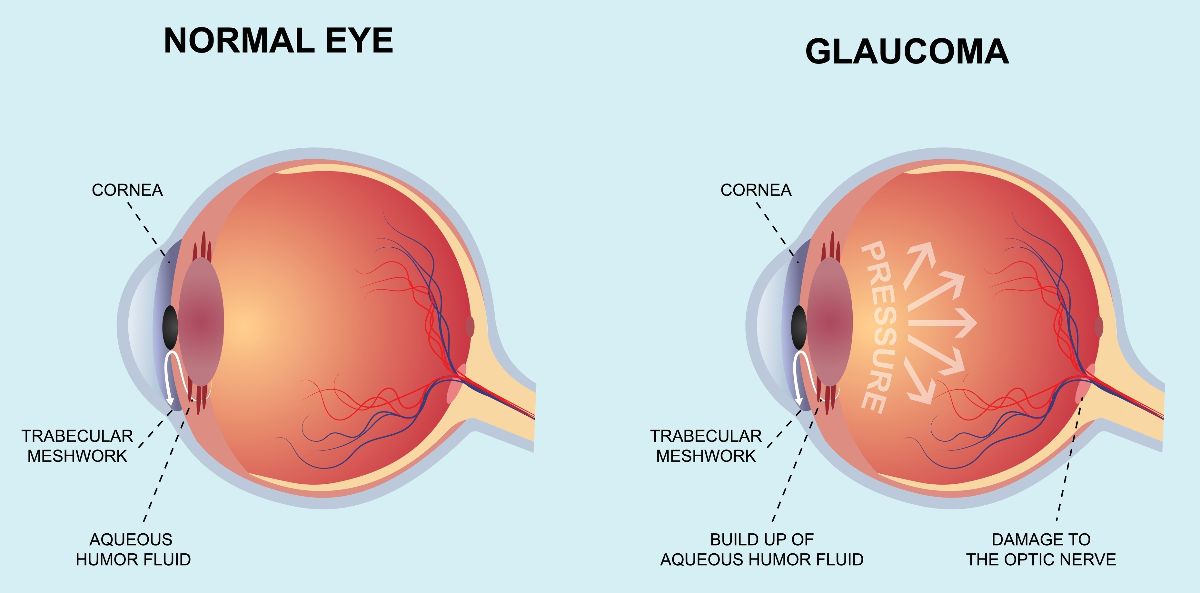glaucoma diagnosis