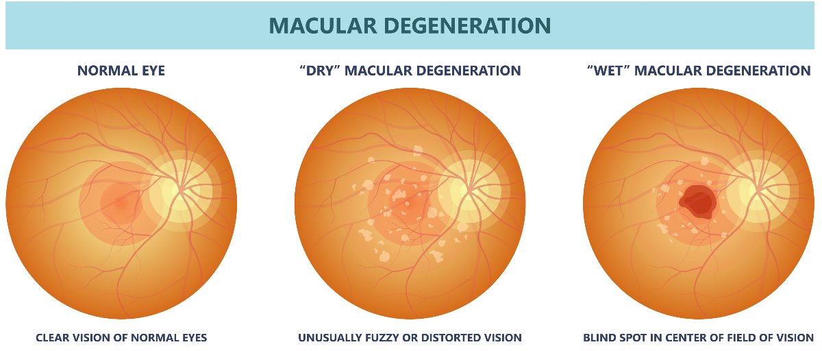 Macular Degeneration Types