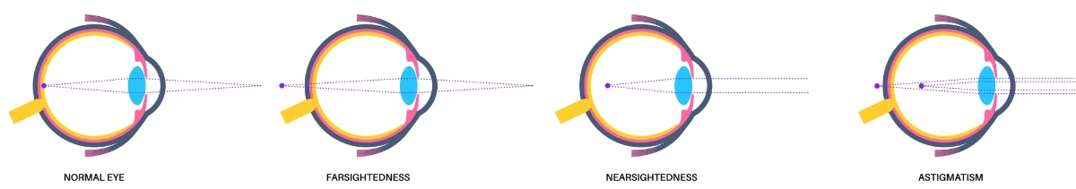 refractive_vision_issues Refractive Vision Errors