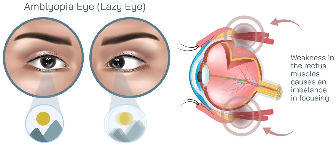 Lazy Eye Explanation