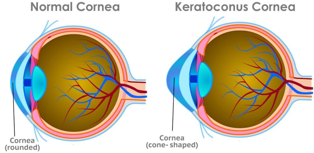 Keratoconus Treatment Melbourne
